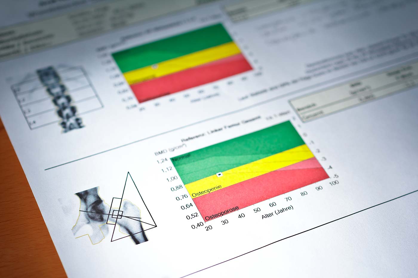 Ergebnisse der DXA Knochendichtemessung mit schematischer Darstellung der Knochen und Graphen