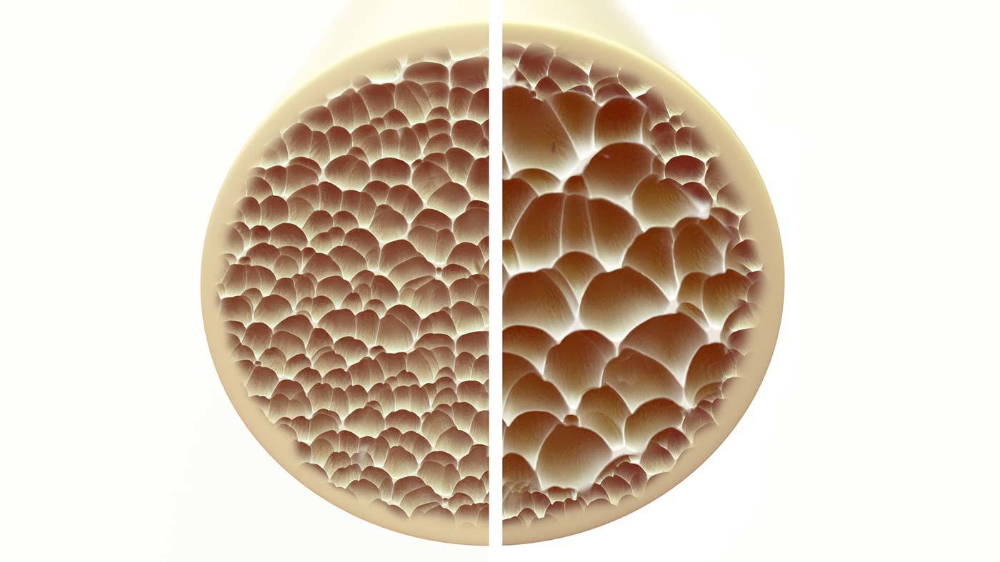 Schematische Darstellung von Osteoporose – gesunde Knochenstruktur vs. poröser Knochen